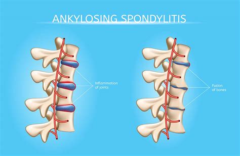 Ankylosing Spondylitis Infusion Therapy Ankylosing Spondylitis