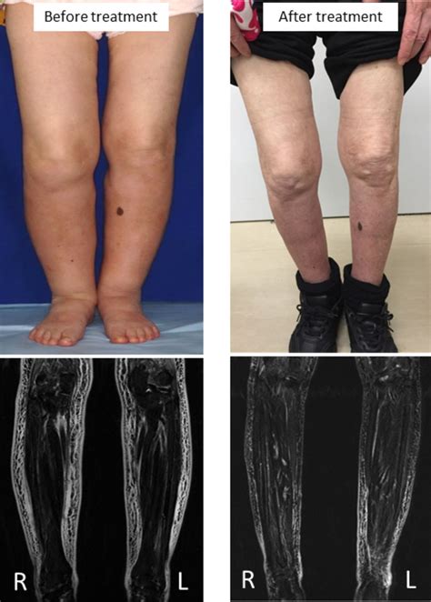 An Uncommon Cause Of Leg Oedema Bmj Case Reports