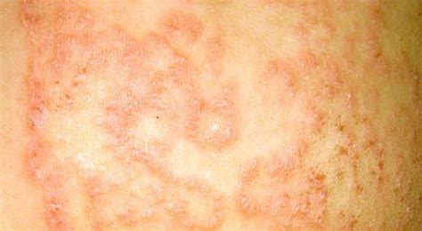 Prev Post1 Of 3next Jock Itch Medically Known As Tinea Cruris Is A