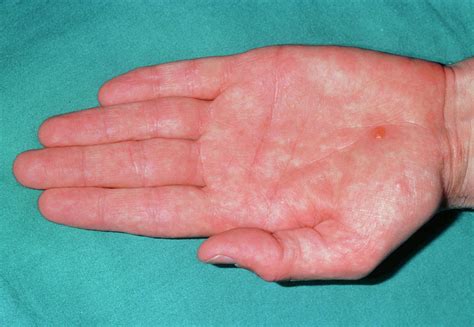 Mild Form Of Pompholyx Eczema Over The Palm Photograph By Dr P