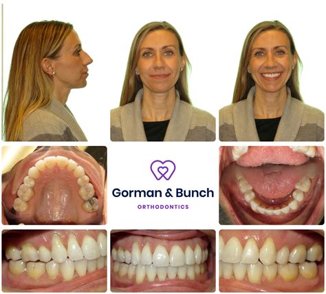 Invisalign Before And After Stories With Our Patients Gorman And