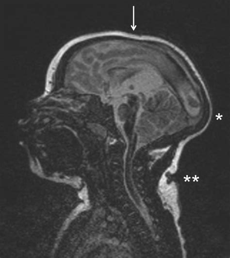 Sagittal Mri Image Of The Head Of An Infant Who Was Born With A Head
