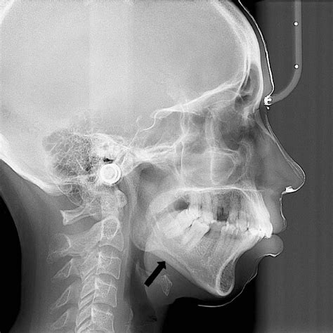 Orthopantomograph Showing Prominent Antegonial Notch On The Right Side