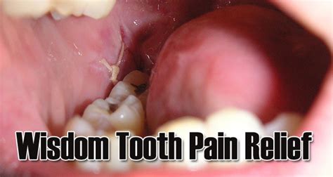 15 Home Remedies For Instant Wisdom Tooth Pain Relief