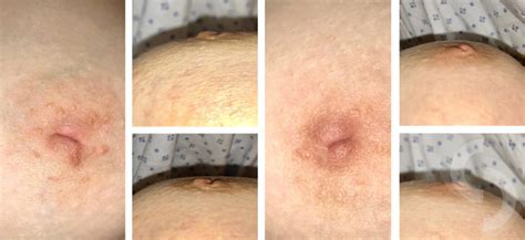Before And After Inverted Nipple Correction Dr Sonja Cerovac