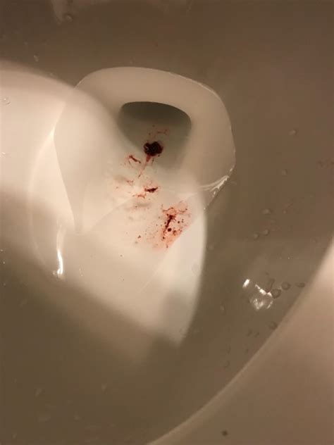 Brownish Red Implantation Bleeding In Toilet Bowl Maternity Photos