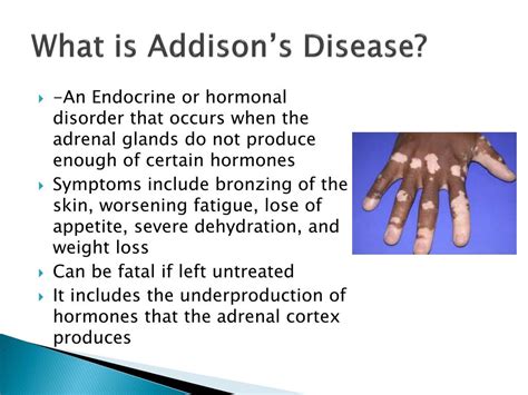 Ppt Addison’s Disease Powerpoint Presentation Free Download Id 1412672