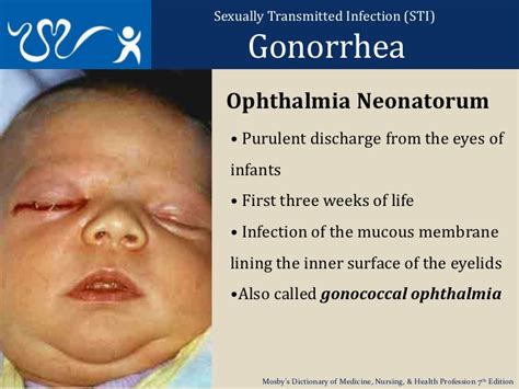 Gonorrheal Ophthalmia Liberal Dictionary