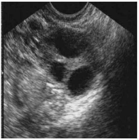 Figure From Ultrasound Ovary Cyst Image Classification With Deep My