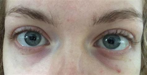 Are Dark Circles Under Eyes A Sign Of Illness