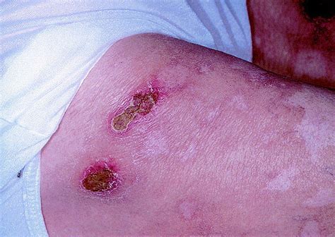 Subcutaneous Panniculitis Like T Cell Lymphoma With Vacuolar Interface
