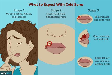Stages Of A Cold Sore Outbreak On Lips Nose And Face