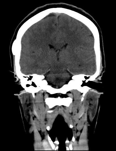 Skull Osteoma Image
