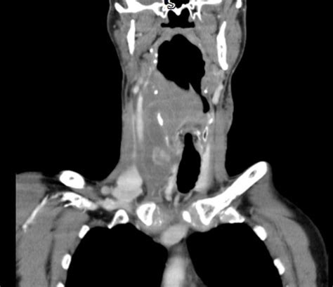 Spontaneous Cervical Haematoma Caused By Extracapsular Haemorrhage From