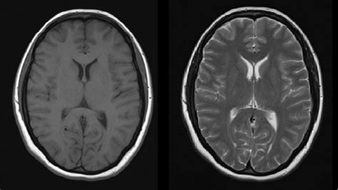 Mri Radiology At St Vincents University Hospital