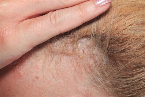 Psoriasis In Hair Remedies That Work Human Hair Exim