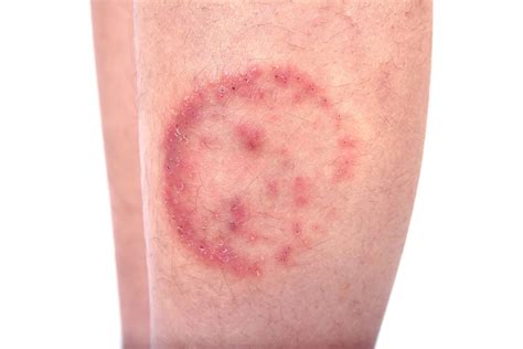 Ringworm Cause Symptoms And Treatment Britannica