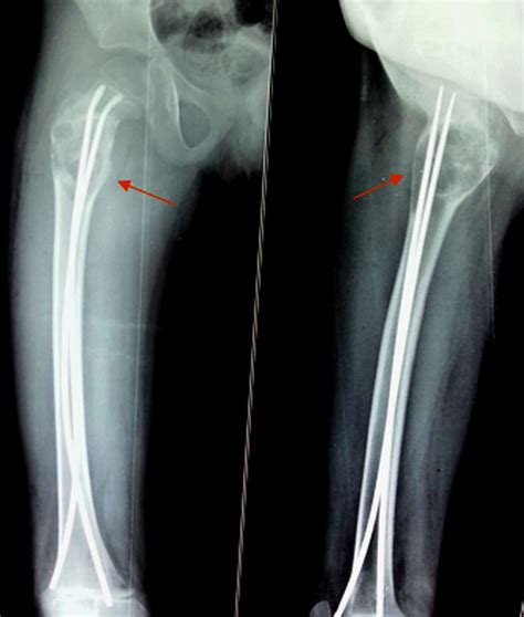 Cureus Aneurysmal Bone Cyst Of The Proximal Femur And Its Management A Case Report