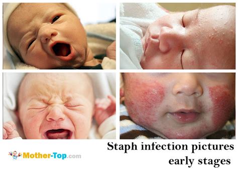 Staph Infection In Babies Pictures Picturemeta
