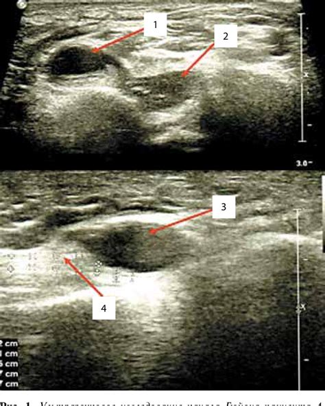 Figure From Ganglion Cyst Of Guyon S Canal As A Rare Cause Of