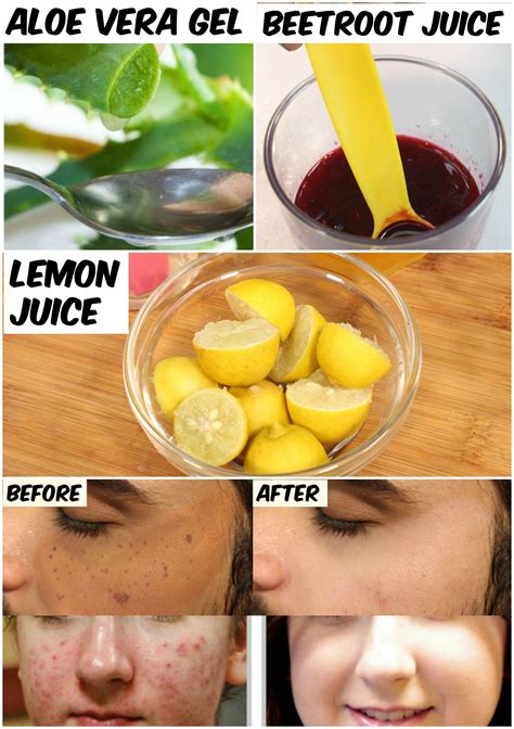 Pin On Get Rid Of Acne
