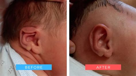 Baby Ear Correction Gallery Before After Examples Dr Onganlar