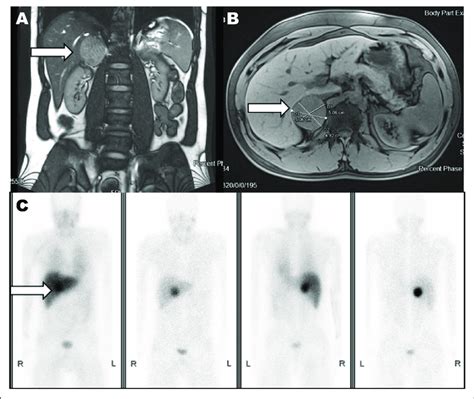 Magnetic Resonance Imaging Depicting Axial Fat Saturated T1 Weighted