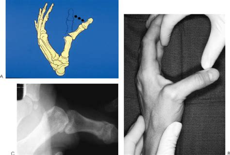 Ulnar Collatreal Ligament Injuries “skiers Thumb” Musculoskeletal Key