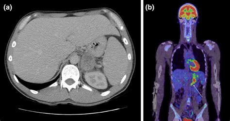 A Axial View Of Contrast Enhanced Computed Tomography Ct Of The