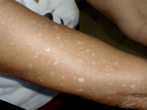 White Spots On Skin From Sun Exposure How To Prevent And Treat