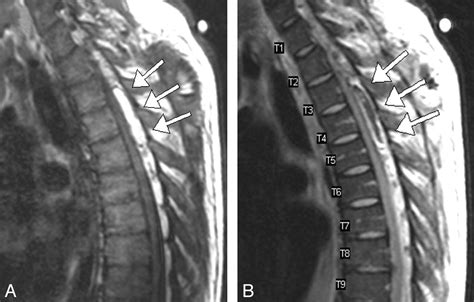 Spinal Epidural Haematoma Symptoms How To Heal