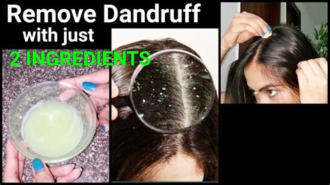 Natural Ways To Do Dandruff Treatment At Home Top 5 Diy