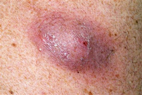 Infected Sebaceous Cyst On Back Photograph By Dr P Marazziscience