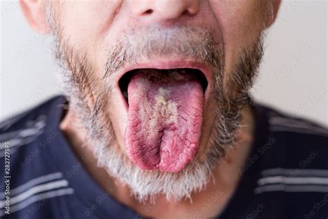 Bacterial Tongue Disease In An Older Man Stock Photo Adobe Stock