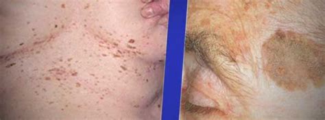 Causes And Treatment Of Brown Skin Spots Pictures And Brochures