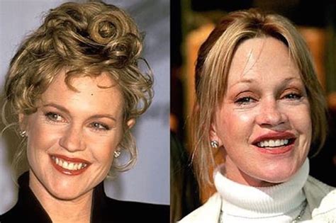 60 Worst Cases Of Celebrity Plastic Surgery Gone Wrong