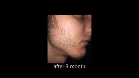 minoxidil for beards Before and after - YouTube