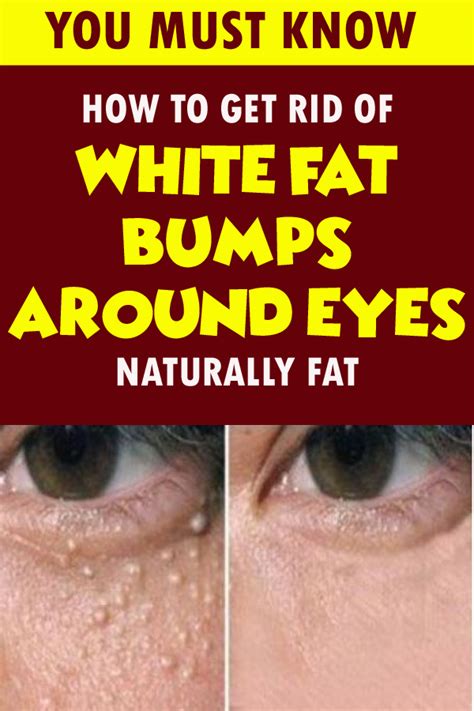 How To Get Rid Of White Fat Bumps Around Eyes Naturally
