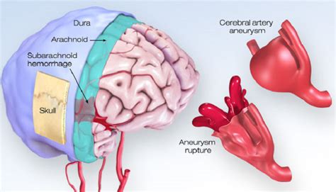 Hemorrhagic stroke, medical treatment, interventional treatment. What You Should Know About Cerebral Aneurysms | American ...