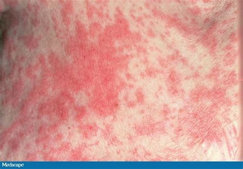 A 75 Year Old Woman With Fever Rash And Skin Pain