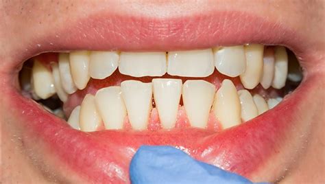Diş Eti Çekilmesi Neden Olur Belirtileri Nelerdir EOT Klinik Ankara