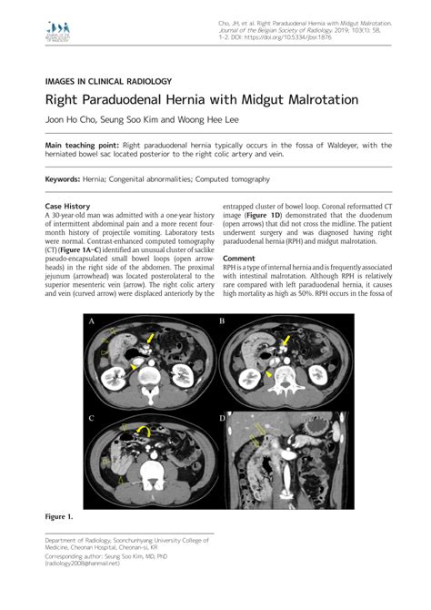 Pdf Right Paraduodenal Hernia With Midgut Malrotation