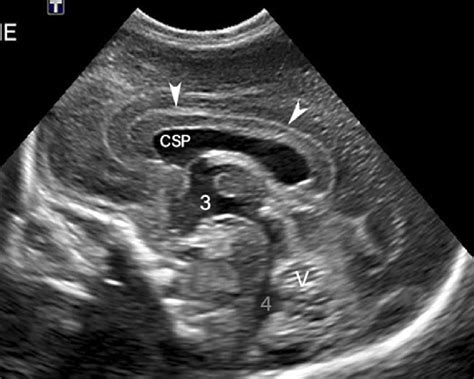 Third Ventricle Neonatal Ultrasound Images And Photos Finder