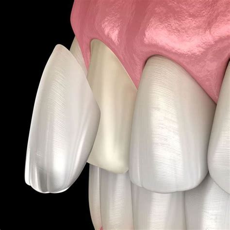 teeth whitening amarillo tx pendergrass and wilkie dentistry