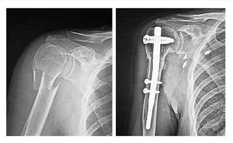 Figure From Treatment Of Proximal Humeral Fracture With A Proximal