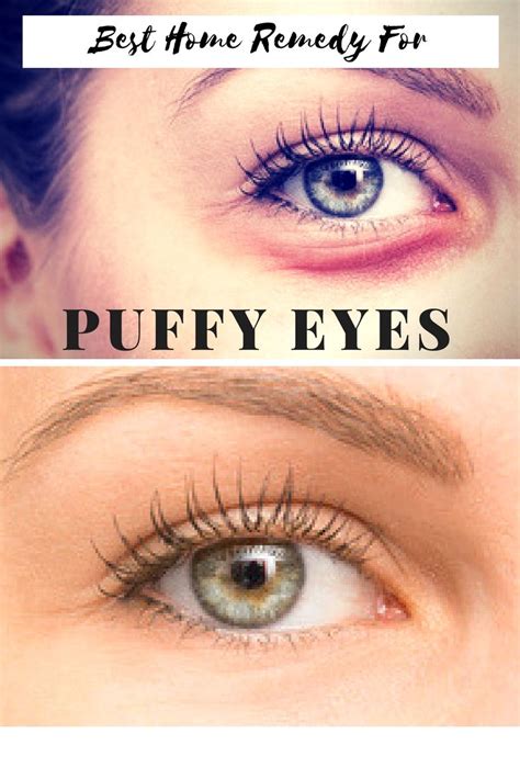 Pin By Timasyrf On Beauty Puffy Eyes Puffy Eyes Remedy Best