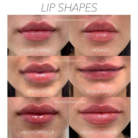 Lip Filler Shapes Healthy Anozo