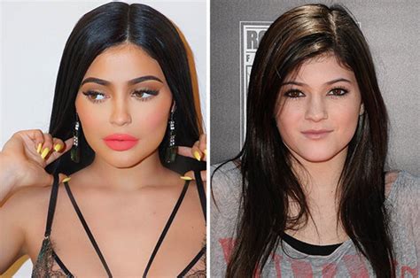 Kylie Jenner Before Surgery Plastic Surgeon Gives Verdict On Starlet S Transformation Daily Star