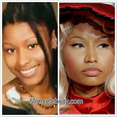 Nicki Minaj Before And After Surgery Face Lift Nicki Minaj Plastic