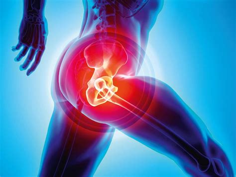 What Is The Main Cause Of Needing A Hip Replacement